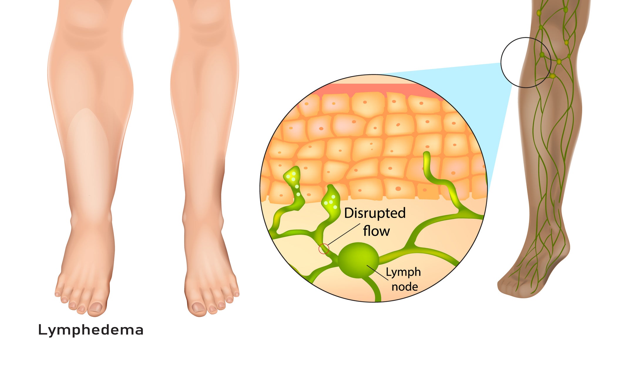 Lymphedema, also known as lymphoedema and lymphatic edema
