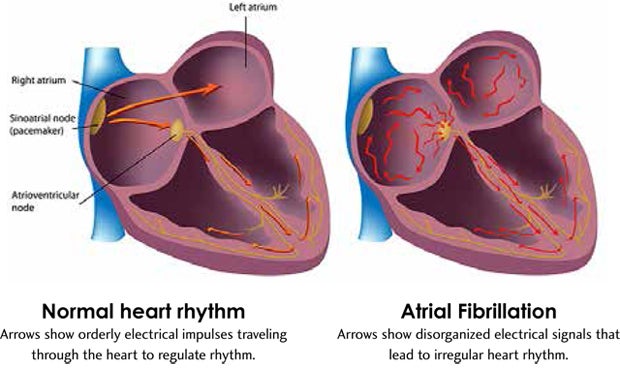 Arrows show electrical impulses during a normal heart rhythm and during atrial fibrillation