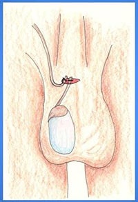 male vasectomy