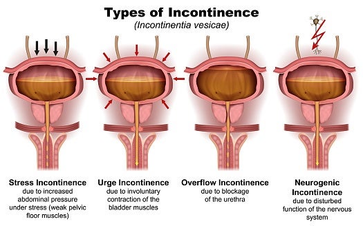 types of urinary incontinence