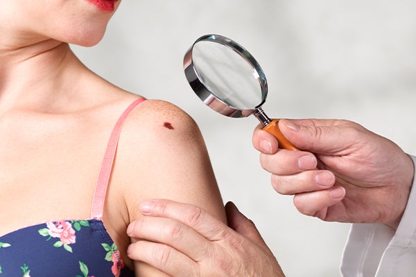 Doctor with magnifying glass looking at rash on shoulder of a girl