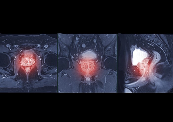 prostate cancer imaging