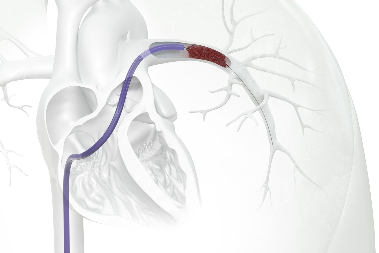 Advanced Care for Patients with Pulmonary Embolism