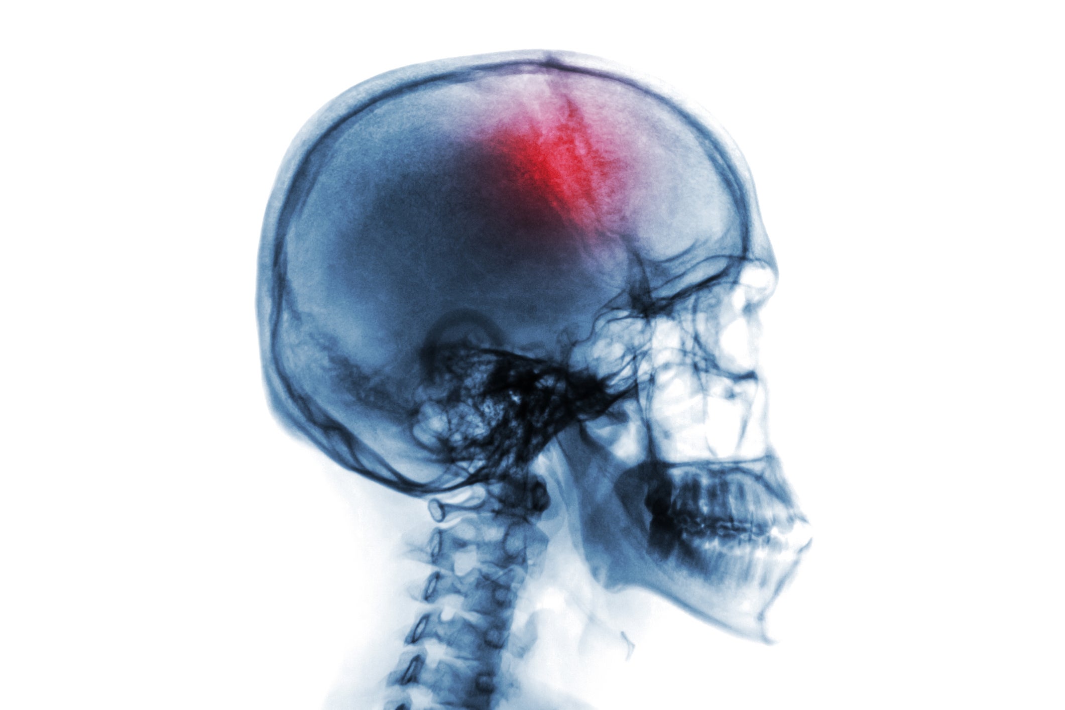 Stroke . Cerebrovascular accident . Film x-ray of human skull and cervical spine .