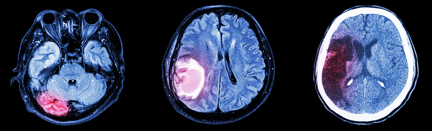 image of three stroke brains