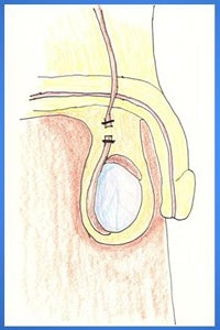 male vasectomy