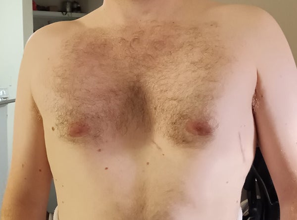 Ben chest before surgery