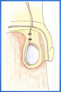 van deferens 4
