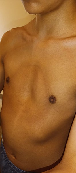 joel's chest after vacuum bell