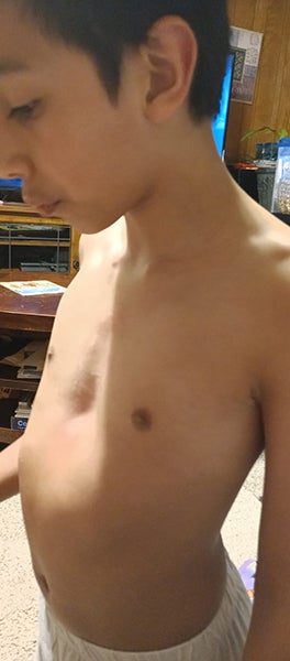 chest indentation
