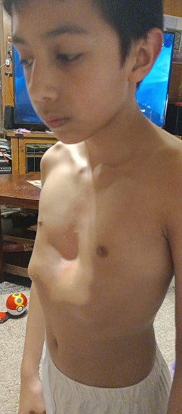 increasing chest indentation
