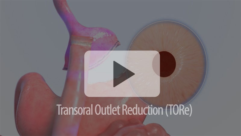 TORe Procedure Animation class=